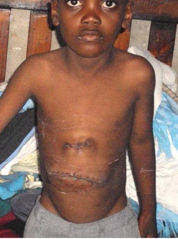 Condition after the operation. The leg and other body parts of the Siamese twin have been removed. Additional medical treatment and checkups will be necessary.